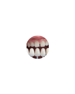 Veneers